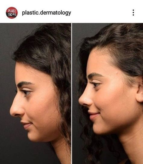 #plasticsurgery #plasticsurgerygonewrong #beforeafter #celebritiesbeforeafter #hollywoodstars #bignosesurgery #surgery #facesurgery #vlinesurgery #koreanplasticsurgery #kpopplasticsurgery #nosejob #jawreductionsurgery #eyesurgery #cheekfillers #rhinoplasty #facelift #plasticsurgeryfails #expensiveplasticsurgery Refined Tip Rhinoplasty, Face Surgery Before And After, Chin Augmentation Before And After, Nose Surgery Before And After, Jaw Surgery Before And After, Rhinoplasty Before After, Nose Job Before And After, Nose Plastic Surgery, Face Plastic Surgery