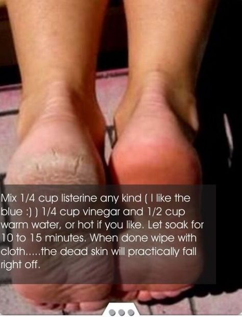 Cracked Skin, Beauty Remedies, Skin Remedies, Keeping Healthy, Health And Beauty Tips, Skin Tips, Beauty Treatments, Diy Beauty, Keratin