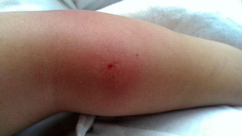 This is why some insect bites swell up - CosmopolitanUK Bug Bite Swelling, Spider Bite Symptoms, Spider Venom, Bug Bite, Spider Bites, Bug Bites, Classy Photography, Insect Bites, Bugs