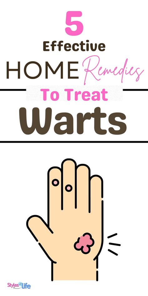 Home Remedies For Warts Home Remedy For Warts, Wart Remedies, Flat Warts, Types Of Warts, Warts On Face, Home Remedies For Warts, Warts Remedy, Get Rid Of Warts, Skin Problems