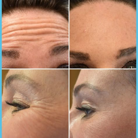 Anti-wrinkle treatments at forever  young aesthetics call 07828293599 for your free consultation Botox Anatomy, Botox Wrinkles, Botox Facial, Botox Cosmetic, Cheek Fillers, Belly Dancing Videos, Skin Care Business, Nurse Inspiration, Anti Wrinkle Treatments