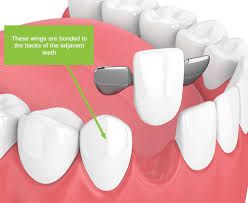 All you need to know about dental bridges | Gentle Dental Care Gaps In Teeth, Gap Between Teeth, Tooth Bridge, Whiten Teeth At Home, Strong Teeth, Invisible Braces, False Teeth, Whiten Teeth, Missing Teeth