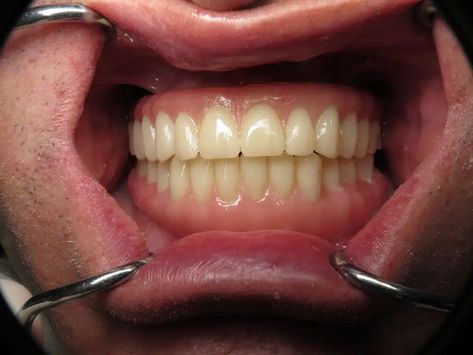 Temporary Full Implant Teeth. Why Do This Step? Rotten Teeth, Teeth Implants, Dental Implant, Dental Implants, Not Perfect, Make Sure, How Many, Arch, Quick Saves