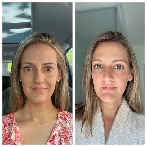 before and after of woman first time botox Botox Brow Lift, Botox Before And After, Frozen Face, Eyebrow Lift, Botox Face, Brazilian Waxing, Brow Lift, Double Chin, Aging Gracefully