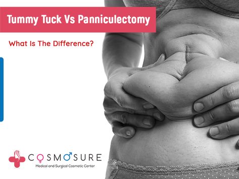 Most people are confused with a tummy tuck and panniculectomy. Both procedures solve the same problem but have differences. Panniculectomy Before And After, Panniculectomy Surgery, Loose Skin Surgery, Skin Removal Surgery, Mommy Makeover Surgery, Body Surgery, Increase Breast Size, Tummy Tucker, Mommy Tummy