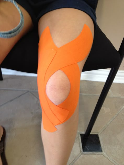 Patellar Tracking Support Kinesio Taping Knee, Kt Tape Knee, Broken Knee, Knee Taping, Physio Tape, Patellofemoral Pain Syndrome, K Tape, Kt Tape, Kinesio Taping