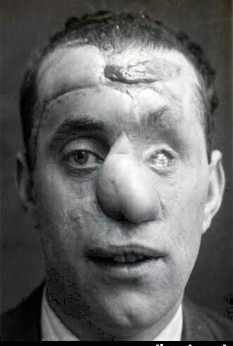 early face reconstruction following WW1 Wwi Soldier, Facial Reconstruction, Human Oddities, Medical Photos, Reconstructive Surgery, Vintage Medical, Human Condition, Medical History, Weird World