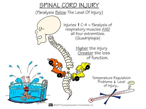 The spinal cord is surrounded by rings of bone called vertebra. These bones constitute the spinal column (back bones). In general, the higher in the spinal column the injury occurs, the more dysfunction a person will experience. Nursing Information, Nursing Board, Med Surg Nursing, Nursing Mnemonics, Surgical Nursing, Medical Surgical Nursing, Nursing School Survival, Nursing School Studying, Nursing School Tips