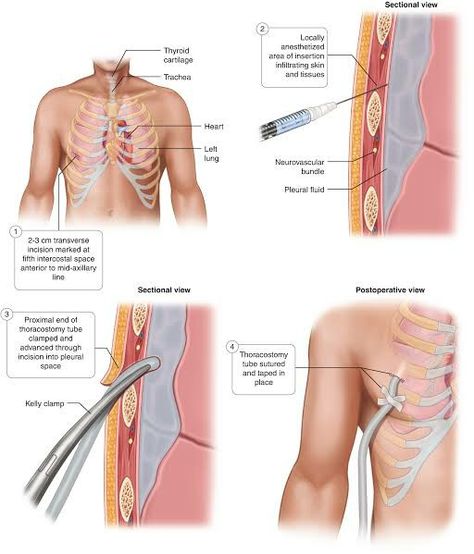 Suture Material, Chest Tube, Latissimus Dorsi, Nursing Notes, Radiology, Ultrasound, Clean Skin, Drain