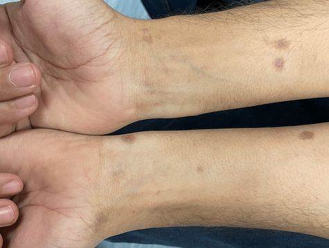 A Rare Case Report: Five Variants of Lichen Planus in a Young Male Patient Lichen Planus, Scar Removal, Resolution, Health