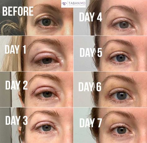 Upper Blepharoplasty Before and After Gallery | Taban MD Best Plastic Surgery Before And After, Blethoplasty Before And After, Upper Eyelid Lift Surgery, Eyelid Lift Surgery Before After, Lower Blephoraplasty Before And After, Upper Blephoraplasty Before And After, Blephoraplasty Before And After, Saggy Eyelids, Kpop Plastic Surgery