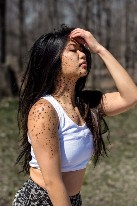 Really inspiring article about overcoming the struggle of being different-This Is What It's Like to Live With Birth Marks Covering Your Face and Body Cool Birth Marks, The Skin I Live In, Different Beauty People, Birthmarks On Face, Face Birthmark, Birthmark On Face, Beauty Marks On Face, Birth Marks, Skin Positivity