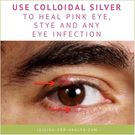 You may have heard that colloidal silver heal eye infections, but never had the need to learn more until you get an eye infection. This article explains how you can use colloidal silver to curb eye infections and heal your eyes, fast ... as in one or two days! Eye Infection Remedies, Stye Remedies Fast, Stye Remedy, Natural Pink Eye Remedy, Stye Remedies, Eye Stye Remedies, Pinkeye Remedies, Silver Benefits, Homemade Medicine