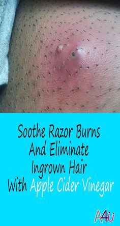 Hairstyles Bubble, Braids Volleyball, Honey Face, Bubble Braids, Chicken Thigh Recipes Baked, Razor Burns, Get Rid Of Blackheads, Skinny Taste Recipes, Makeup Looks For Brown Eyes