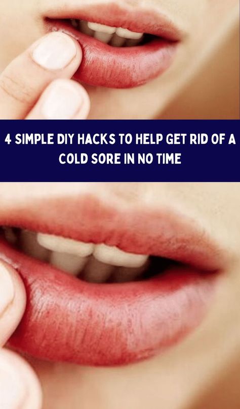 4 Simple DIY Hacks To Help Get Rid Of A Cold Sore In No Time How To Stop A Cold Sore Before It Starts, Fast Cold Sore Remedy, How To Heal A Cold Sore Fast, How To Treat Cold Sores Fast, Lysine For Cold Sores, Home Remedy For Cold Sore On Lip, How To Get Rid Of A Cold Sore Fast, How To Get Rid Of Cold Sores, How To Get Rid Of Cold Sores Overnight