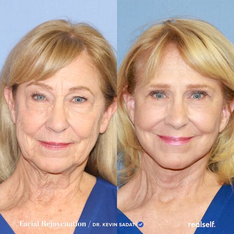 Sagging Skin Face, Mid Face Lift, Lower Face Lift, Neck Lift Surgery, Mini Face Lift, Facelift Surgery, Facelift Before And After, Sagging Cheeks, Face Lift Surgery