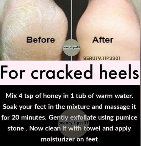 Foot Whitening Remedies, Legs At Home, Natural Skin Care Ingredients, Clear Healthy Skin, Natural Skin Care Remedies, Natural Face Skin Care, Good Skin Tips, Basic Skin Care Routine, Skin Care Wrinkles