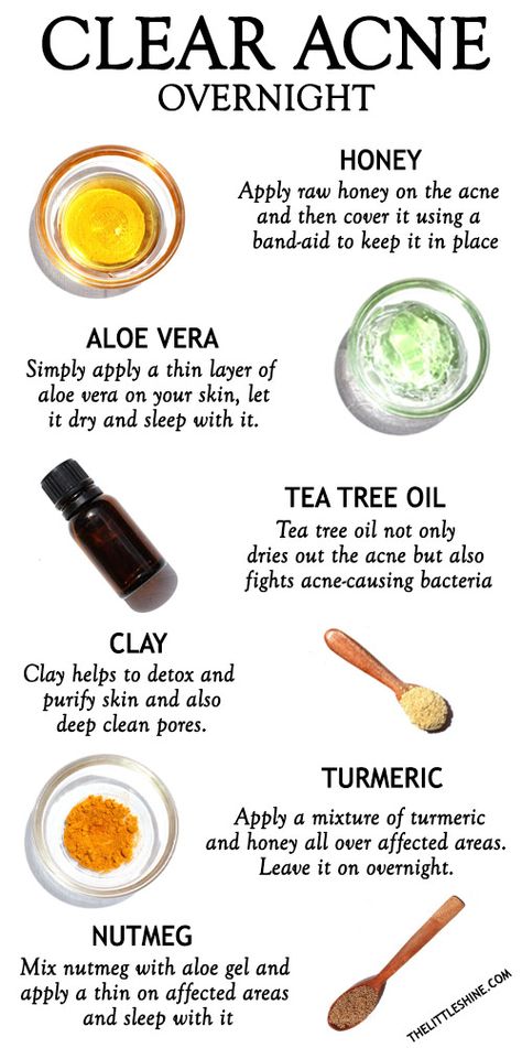 Clear Acne Overnight, Clear Skin Overnight, Lotion For Oily Skin, Turmeric And Honey, Acne Overnight, Natural Acne Remedies, Natural Acne, How To Get Rid Of Pimples, Aloe Gel