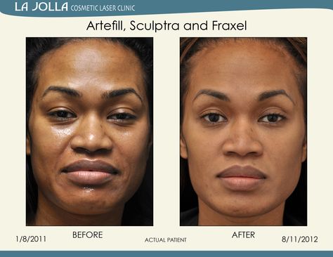 Patient treated with Artefill, Sculptra and Fraxel at La Jolla Cosmetic Laser Clinic. Sculptra Before And After Faces, Fraxel Laser Before And After, Sculptra Before And After, Fraxel Before And After, Fraxel Laser, Laser Clinic, Laser Clinics, La Jolla, Face And Body