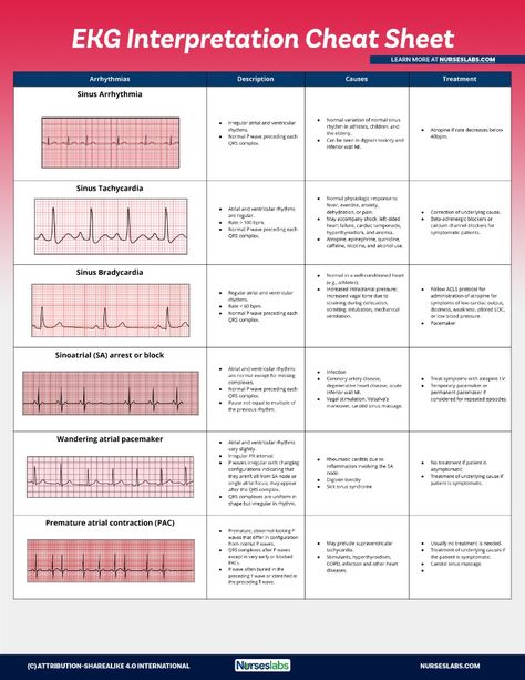 Use this EKG interpretation cheat sheet that summarizes all heart arrhythmias in an easy-to-understand fashion. Cardiac Rhythms Ekg Interpretation, Cardiac Dysrhythmias Cheat Sheets, Arrhythmias Nursing Cheat Sheets, Heart Rythym Chart, Ekg Rhythms Cheat Sheets, Heart Rhythm Nursing Cheat Sheets, Ekg Interpretation Made Easy Cheat Sheets, Cardiac Rhythms Cheat Sheets, Telemetry Nursing Cheat Sheets