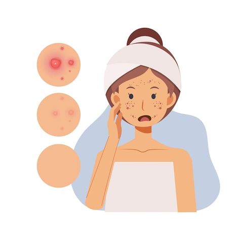 Problem skin concept. woman with pimples... | Premium Vector #Freepik #vector #acne-skin #acne-face #skin-problem #pimple Acne Animation, Skin Problems Face, Acne Drawing, Acne Illustration, Cartoon Character Illustration, Problem Skin, Pimples On Face, Acne Face, Natural Acne Remedies