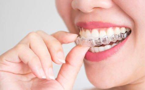 Everyone wants to have a beautiful smile that is paired with pearly white teeth. Not having great looking teeth can take a toll on your confidence. If you have a crooked smile, crowded teeth, or unsightly gaps, chances are that you will feel embarrassed when smiling. However, it does not mean that you should opt … How Does Invisalign Work – Everything You Need to Know Read More » The post How Does Invisalign Work – Everything You Need to Know appeared first on Life With He Clear Aligner, Invisalign Aligners, Invisalign Braces, Misaligned Teeth, Denture Implants, Teeth Alignment, Traditional Braces, Invisible Braces, Kedokteran Gigi