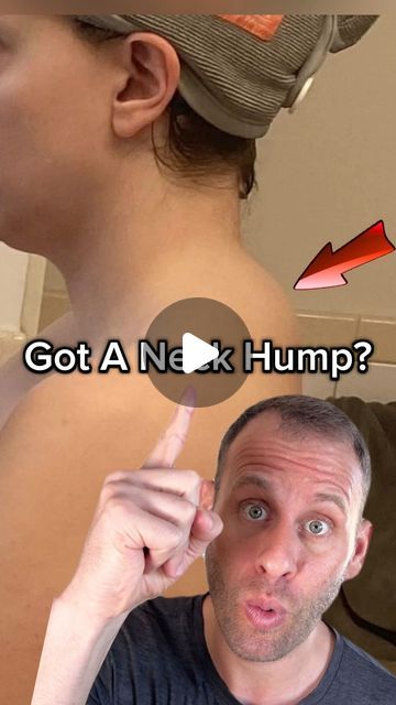 Dowagers Neck Exercises, Hump On Back Of Neck, Turkey Neck Exercises, Dowager Hump, Dowager's Hump, Targeted Exercises, Neck Hump, Neck Exercises, Poor Posture