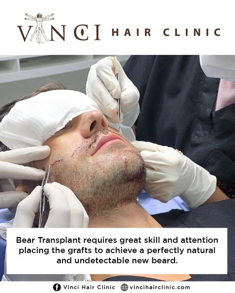 Vinci Hair Clinic beard hair transplant surgery makes it possible to achieve the facial hair of your dreams. #beard Beard Transplant, Hair Transplant Surgery, Beard Hair, Hair Clinic, Full Beard, Beard No Mustache, Hair Restoration, Hair Transplant, Hair And Beard Styles