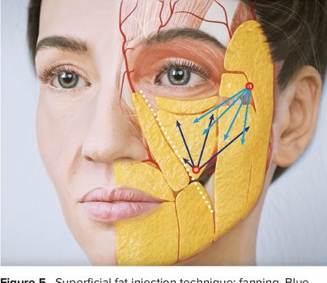 Figure 5 from Injection Guidelines for Treating Midface Volume Deficiency With Hyaluronic Acid Fillers: The ATP Approach (Anatomy, Techniques, Products) | Semantic Scholar Anatomy Techniques, Botox Injection Sites, Facial Injections, Aesthetic Surgery, Aesthetic Dermatology, Products Aesthetic, Hyaluronic Acid Fillers, Facial Anatomy, Facial Fillers