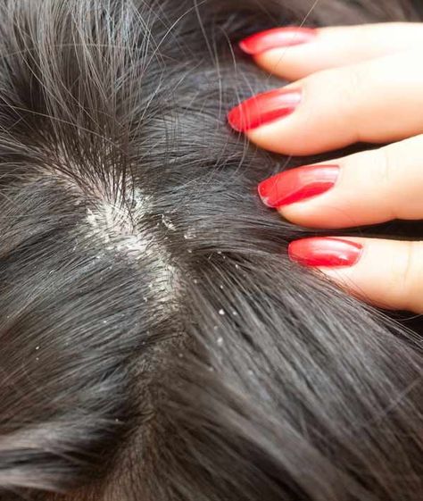 9 Simple Home Remedies For Dandruff That Worked Wonders For Me | StyleCraze Dry Flaky Scalp, Dandruff Solutions, Home Remedies For Dandruff, Rid Of Dandruff, Dandruff Remedy, Getting Rid Of Dandruff, Kuchu Designs, Flaky Scalp, Beauty Night