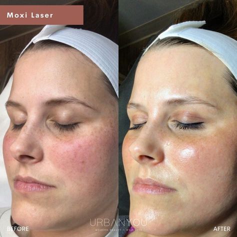 Moxi Laser | Before and After Moxi Laser, The Beauty Standard, Laser Skin Resurfacing, Skin Wrinkles, Light Sun, Lip Filler, Cell Growth, Skin Resurfacing, Laser Skin