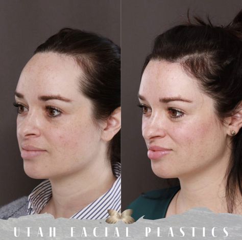 You Can Fix A Large Forehead With Forehead Reduction Surgery Forehead Lowering Surgery, Forehead Surgery, Forehead Reduction Surgery, Large Forehead, Forehead Reduction, Surgical Procedures, Reduction Surgery, Facial Plastic, Plastic Surgeon