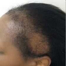 How To Stop Hair Line And Root Damage Due To Protective Styles  Read the article here - http://www.blackhairinformation.com/general-articles/tips/stop-hair-line-root-damage-due-protective-styles/ #hairline #edges #protectivestyles Thining Hair, Hair Edges, Relaxed Hair Care, Edges Hair, Hair Line, Bald Hair, Regrow Hair, Make Hair, Black Hair Care