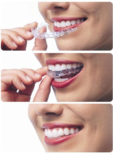 Invisalign Aligners, Dental Social Media, Dental Images, Dental Posters, Invisible Braces, Dental Fun, Dental Braces, Straight Teeth, Metal Braces