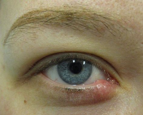 An external stye on the lower eyelid. Stye Remedy, Severe Acne Remedies, Eye Stye Remedies, Swollen Eyelid, Toenail Fungus Remedies, Proper Skin Care, Best Essential Oils, Better Skin, Skin Care Regimen