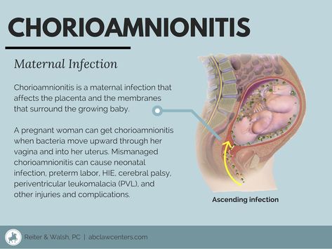 Uterine Rupture Nursing, Obstetrics Nursing, Certified Nurse Midwife, Newborn Nursing, Midwifery Student, Student Midwife, Nursing School Essential, Nursing Mnemonics, Ob Nursing