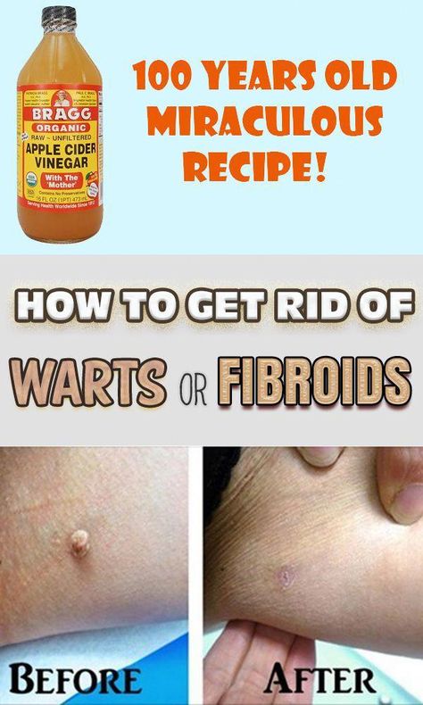 Warts On Hands, Apple Cider Vinegar Recipes, Warts On Face, Remove Warts, Unfiltered Apple Cider Vinegar, Apple Vinegar, Get Rid Of Warts, Skin Tags, Natural Cold Remedies