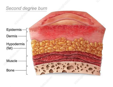 Skin Anatomy, Degree Burns, Medical Notes, Skin Layers, Art Photography Portrait, Nursing School Notes, Science Photos, Layers Of Skin, Medical Illustration