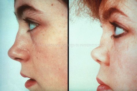 Early saddle-nose deformity is seen in a 15-year-old girl with Wegener’s granulomatosis diagnosed 6 months after the onset of bloody rhinorrhea. Right, Progression of the saddle-nose deformity is evident in this photograph of the same patient taken 3 years later. What Type Of Nose Do I Have, Saddle Nose Deformity, Uneven Nostrils, Nostril Reduction, Conception Tips, Big Nose Memes Funny, Ovulation Tracking, Medical Words, Fertility Awareness