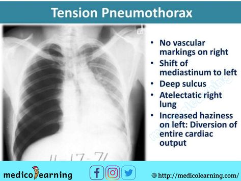 Chest X-ray interpretation Chest X Ray, Chest Xray, Medical Radiography, Medical Mnemonics, Radiology Imaging, Radiology Technologist, Medical Pictures, Pulmonology, Respiratory Care