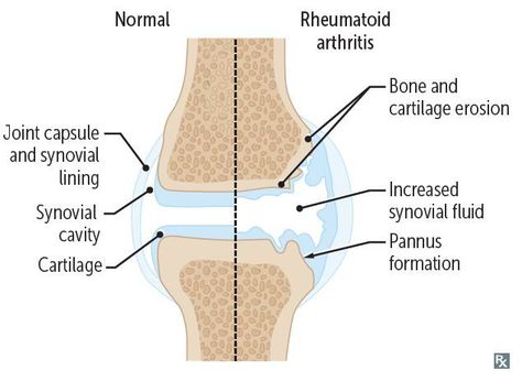 Pannus is an abnormal layer of fibrovascular tissue or granulation tissue Granulation Tissue, Synovial Fluid, African Wear, Cavities, Bones, Quick Saves