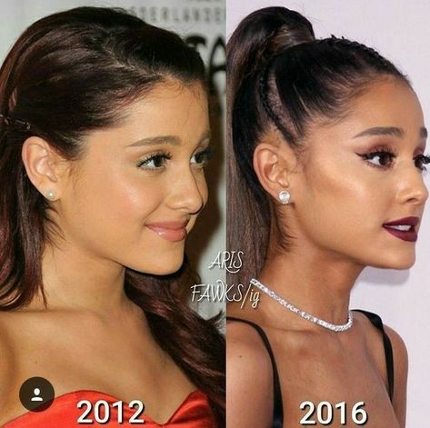 Ariana Grande  Before and After Surgery Ariana Grande Jawline, Ariana Grande Nose, Jaw Surgery, Medical Hospital, Dentist Doctor, Facial Contouring, Perfect Nose, Nose Surgery, Facial Plastic Surgery