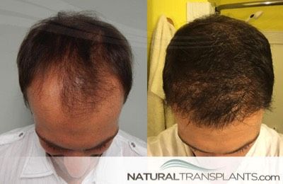 What is a Hair Transplant and How Much Does it Cost? Contact us at Natural Transplants, Hair Restoration Clinic by calling 844-327-HAIR (4247) or visit https://naturaltransplants.com/ for videos, photos and great hair transplant information. Hair Implants, Hair Transplant Cost, Hair Transplant Results, Hair Transplant Procedure, Dunner Wordend Haar, Hair Doctor, Fue Hair Transplant, Hair Transplant Surgery, Best Hair Transplant