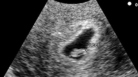 Your 6-Week Ultrasound: What You Can Expect to See 5 Week Ultrasound Pictures, 5 Weeks Pregnant Ultrasound, 6 Weeks Pregnant Ultrasound, Boy Ultrasound, Twins Ultrasound, Ultrasound Gender, 7 Weeks Pregnant, 6 Weeks Pregnant, Baby Announcement To Husband