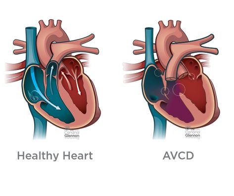 Atrioventricular canal defect (AVCD), also known as atrioventricular septal defect (AVSD) or AV Canal, is a heart defect in the part of the heart that connects the atria to the ventricles. Learn how we treat this condition at SSM Health Cardinal Glennon St. Louis Fetal Care Institute. Cardiothoracic Surgery, Tricuspid Valve, Parts Of The Heart, Open Heart Surgery, Congenital Heart Defect, Heart Defect, Congenital Heart, Neonatal Intensive Care Unit, Heart Conditions