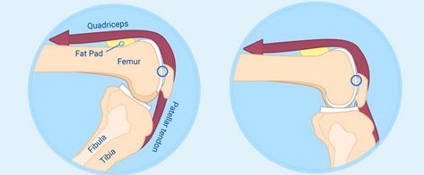 Five Factors of Patellofemoral Pain Syndrome Vastus Medialis, Patellofemoral Pain Syndrome, Gluteus Medius, Best Exercises, Athletic Training, Knee Pain, Physical Therapy, Muscles, Acting