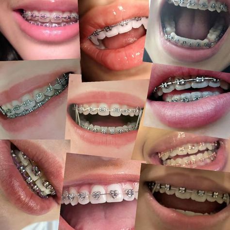 Silver Power Chain Braces, Silver Braces Color, Heart Braces, Color Of Braces, Brackets Aesthetic, Best Braces Colors, Trippy Tattoo Designs, Braces Aesthetic, Braces Colors Combinations