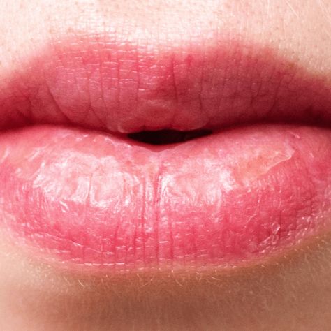 DIY Lip Balm To Revive Dry, Chapped Lips - Advice From Nobody Chapped Lips Remedy Severe, Remedies For Chapped Lips, Chapped Lips Remedy, Lip Healing, Lip Balm Recipes, Lip Care Routine, Diy Lip Balm, Cracked Lips, Diy Lips