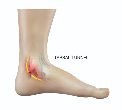 By Dr. Steven Gershman, DPM What is Tarsal Tunnel Syndrome? While many people have never heard of tarsal tunnel syndrome, most have heard of or actually have been diagnosed with carpal tunnel syndrome. Carpal tunnel syndrome affects the arms, wrists, and hands. It is basically a nerve entrapment causing pain, electrica Tarsal Tunnel, Swollen Ankles, Sprained Ankle, Sciatic Nerve, Carpal Tunnel, Scar Tissue, Body Pain, Low Back Pain, Foot Pain