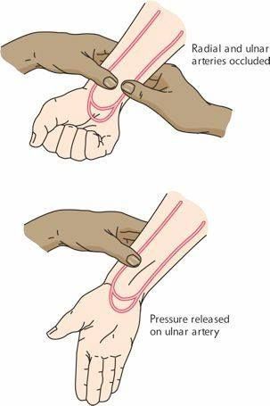 Allen Test: "Hold patient's hand with palm up. Have patient clench and unclench hand while occluding radial and ulnar arteries. The hand will become pale. Lower the hand and have patient relax the hand. While continuing to hold radial artery, release pressure on ulnar artery. Brisk return of color (5 to 7 seconds) demonstrates adequate ulnar blood flow. If pallor persists for more than 15 seconds, ulnar flow is inadequate and radial artery cannulation should not be attempted." Radial Artery, Np School, Nursing Assessment, Respiratory Care, Nurse Rock, Respiratory Therapy, Nursing School Tips, Phlebotomy, Respiratory Therapist